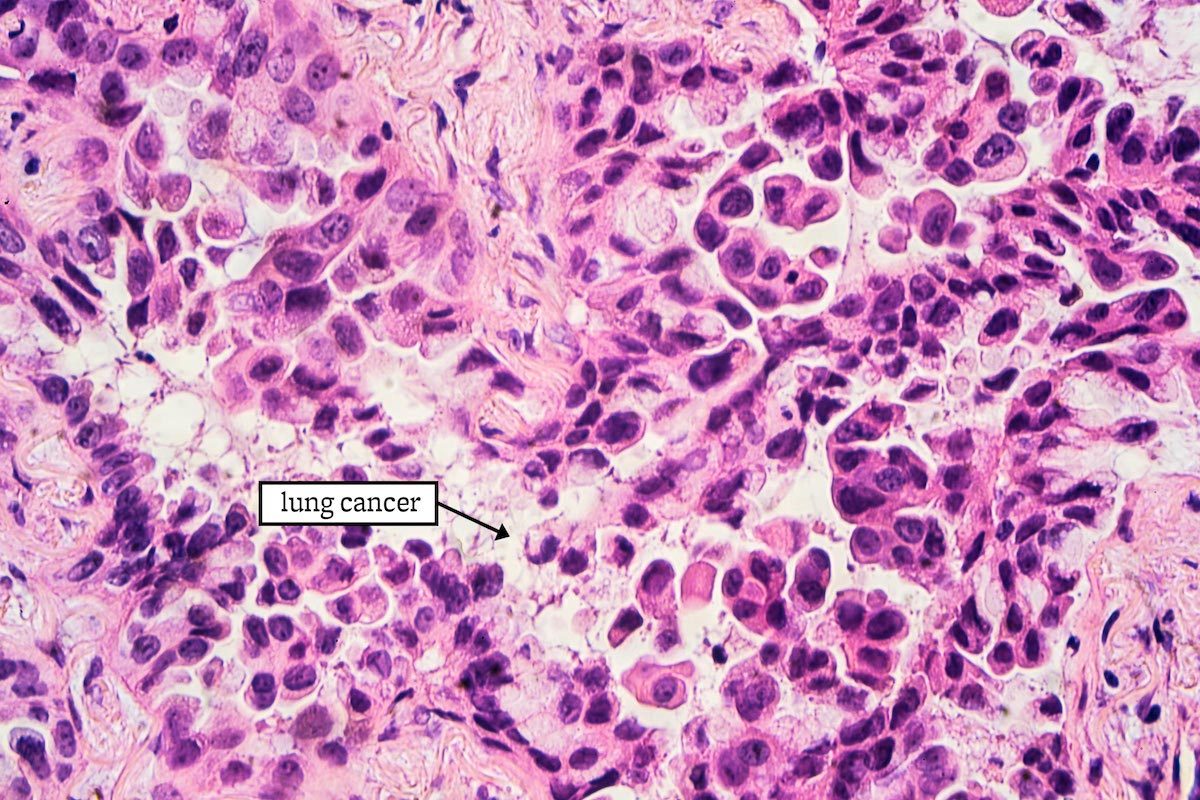 23 Groundbreaking Cancer Research That Could Save Your Life